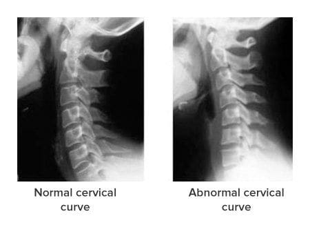 Blog Image 2 - Abnormal Curve