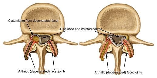 Blog Image 2 - Facet Joint Arthritis