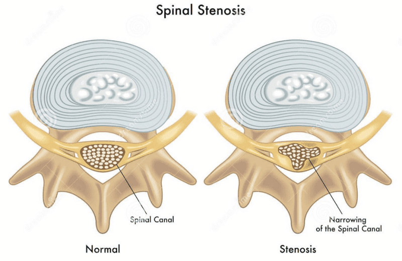 Blog Image 2 - Relief Spinal Stenosis Diagram