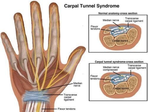 Síndrome del túnel carpiano: diagnóstico y tratamiento