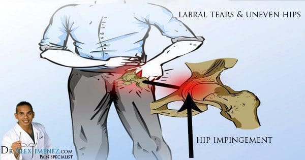 blog picture of labral tears