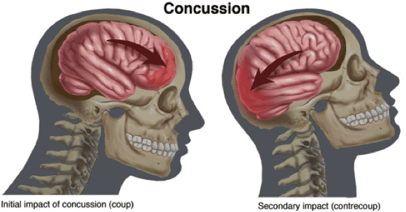 The Importance of Concussion Tests for Brain Injury Evaluation