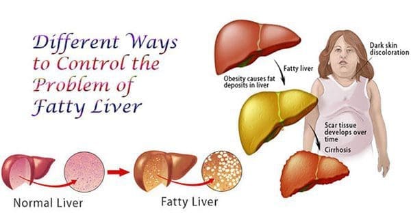 blog illustration of a fatty liver