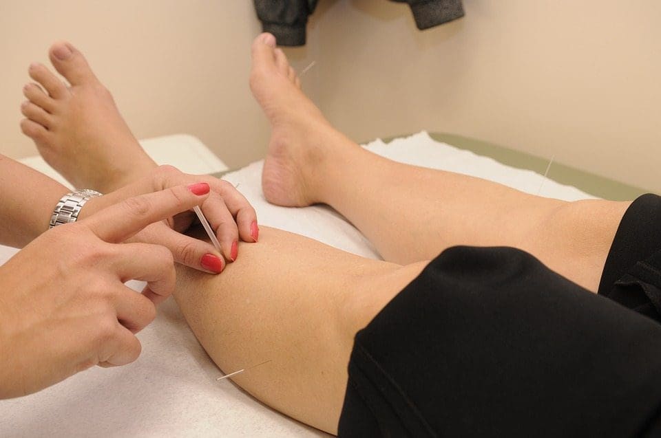 The Benefits of Acupuncture for Arthritis Relief