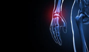 Scaphoid Fracture: Insights into Diagnosis and Care