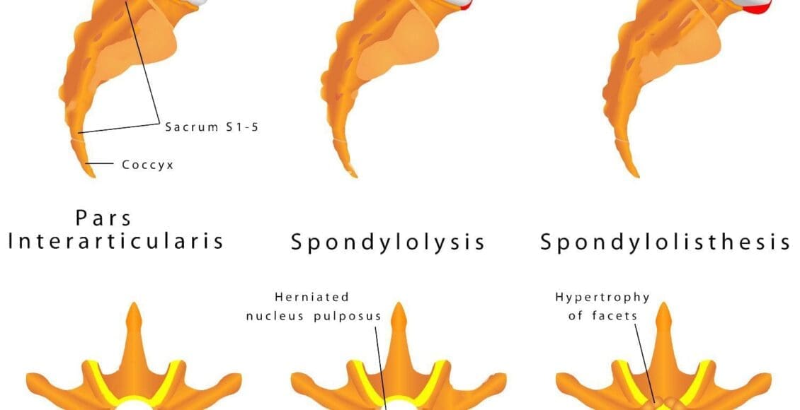 spine fracture spondylolysis spondylolisthesis is a defect in the bony ring comprising