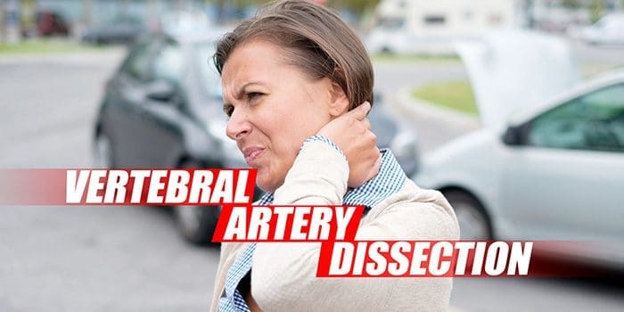 vertebral arteriyanın diseksiyası