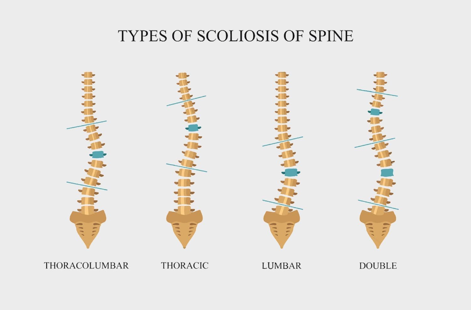 scoliosis treatment el paso tx.