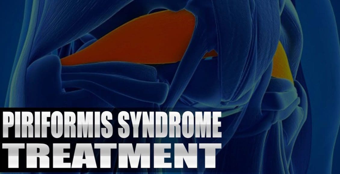 trattamento con sindrome piriforme el paso tx.
