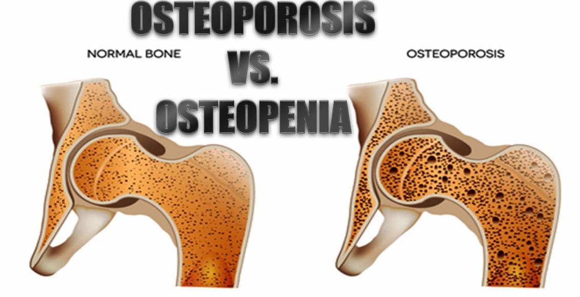 osteoporoosi el paso tx.