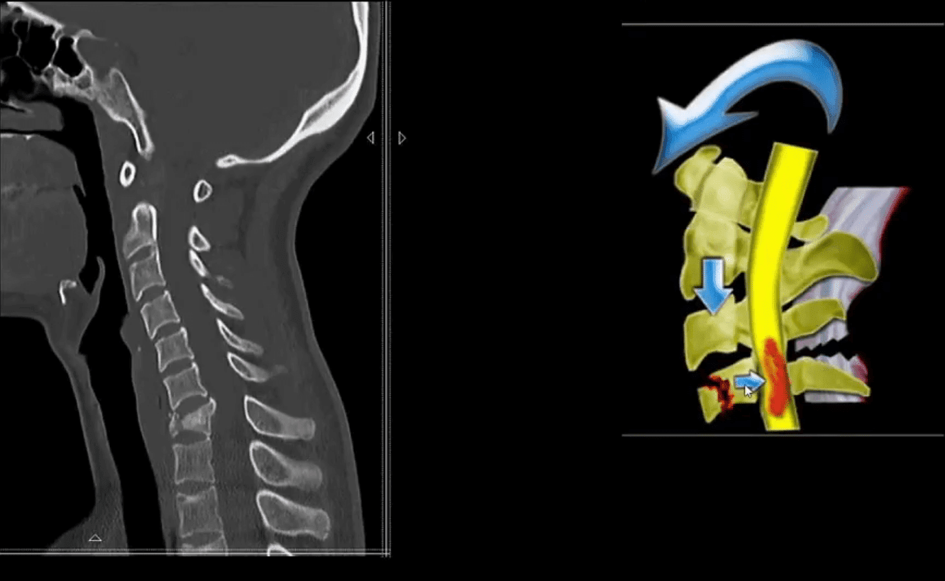 spinal trauma el paso tx.