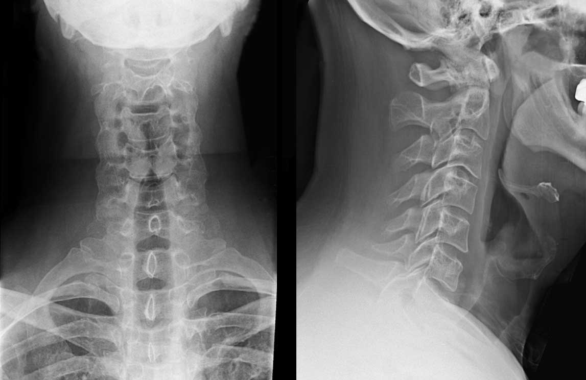 Рентгенограммы шейного отдела позвоночника у пациента с травмой | El Paso, TX Chiropractor