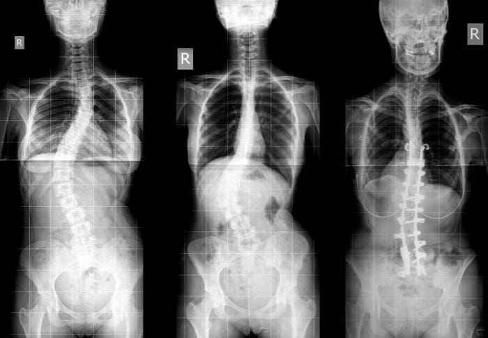 Imaging Diagnostics of Abnormalities of the Spine, Scoliosis, Spondylolysis & Spondylolisthesis | El Paso, TX Chiropractor