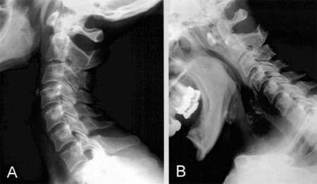 Imaging the Spine in Arthritis | El Paso, TX Chiropractor