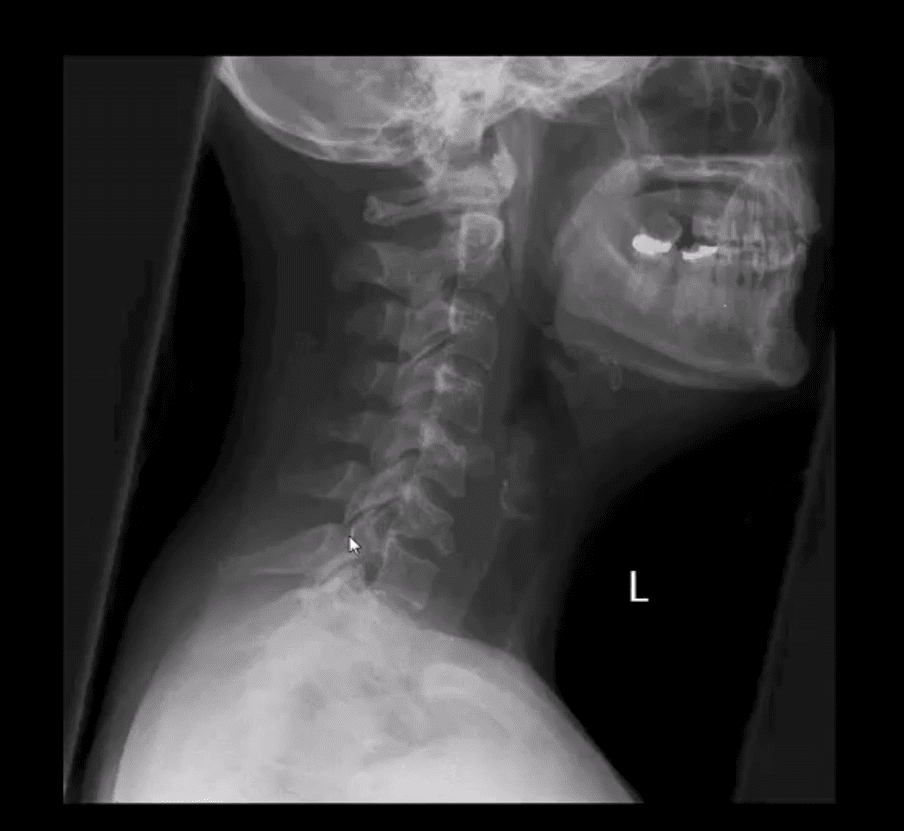 spinal trauma el paso tx.