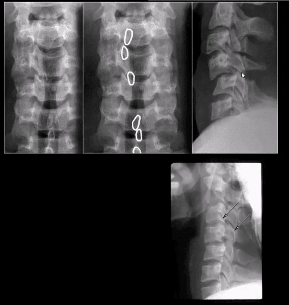 spinal trauma el paso tx.