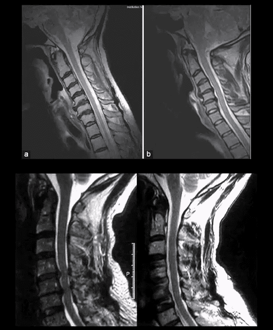 spinal arthritis el paso tx.