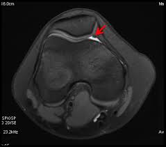 O que é a Síndrome de Knee Plica? El Paso, TX Chiropractor