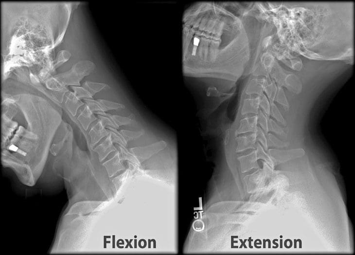 Revmatoidni artritis vratne hrbtenice | El Paso, TX Kiropraktik