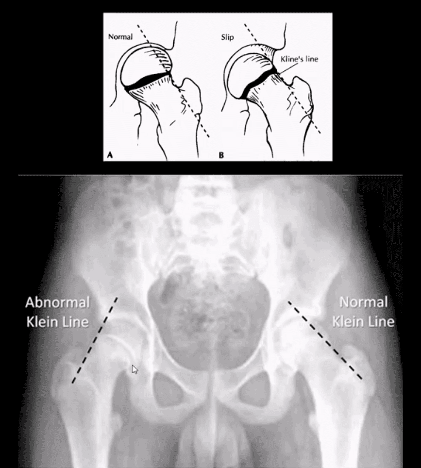 diagnosi artrite e neoplasie dell'anca el paso, tx.