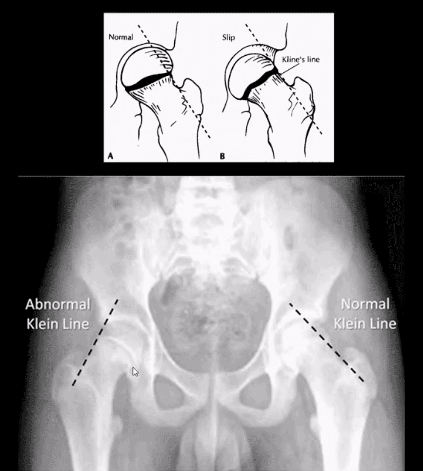 Diagnóstico de artritis de cadera y neoplasias del paso, tx.