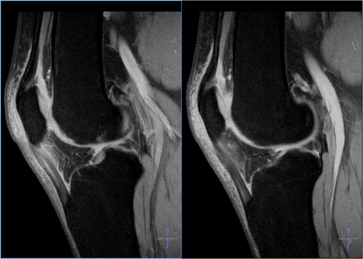 Imaging diagnostics demonstrating patellar tendinitis or jumper's knee.