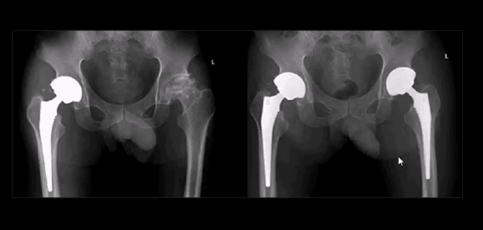 Diagnóstico de artritis de cadera y neoplasias del paso, tx.