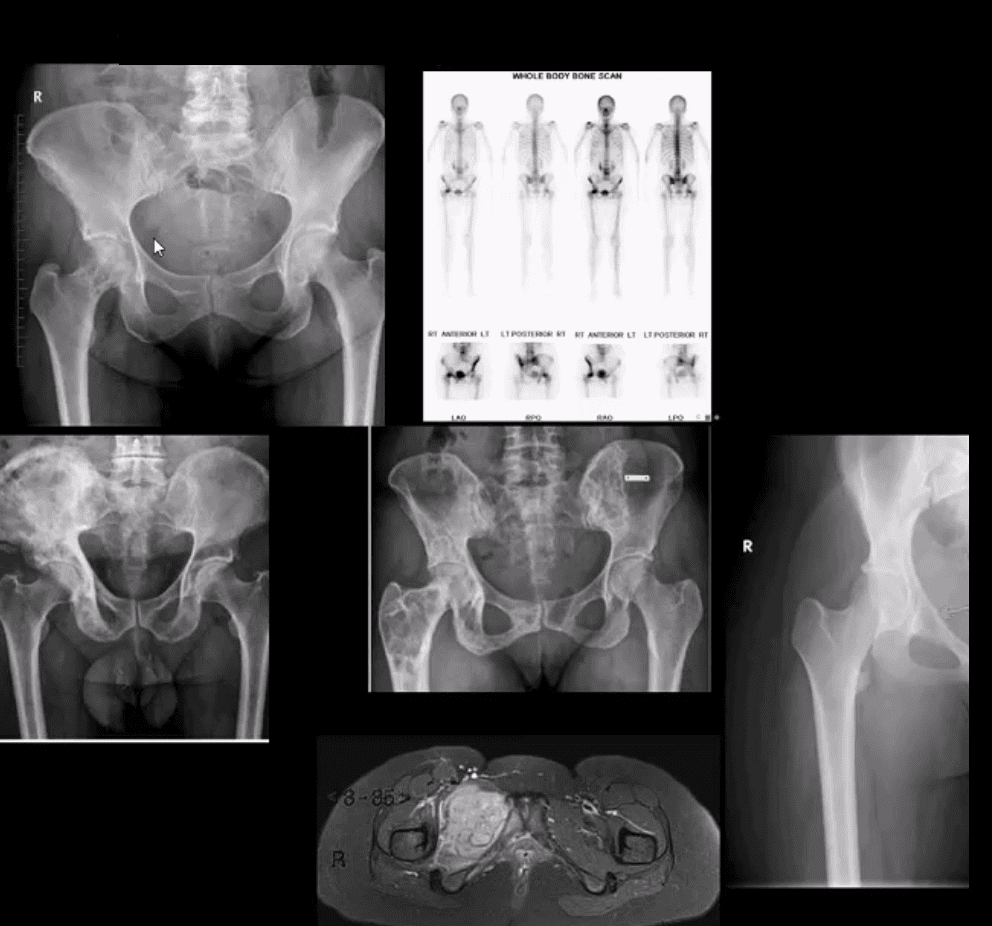 Diagnóstico de artritis de cadera y neoplasias del paso, tx.
