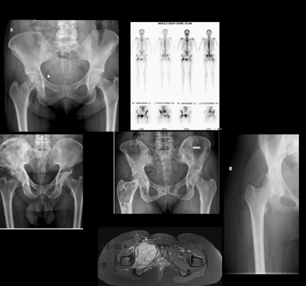 diagnozė klubo artritas ir navikai el paso, tx.