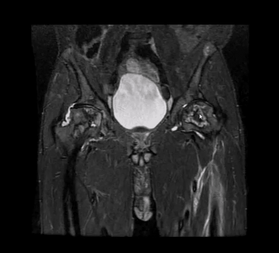 Diagnóstico de artritis de cadera y neoplasias del paso, tx.