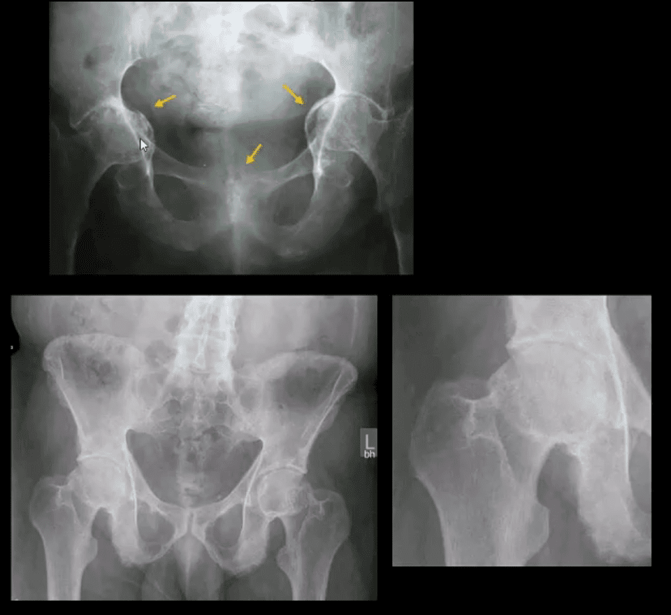 diagnose hofteledsgigt og neoplasmer el paso, tx.