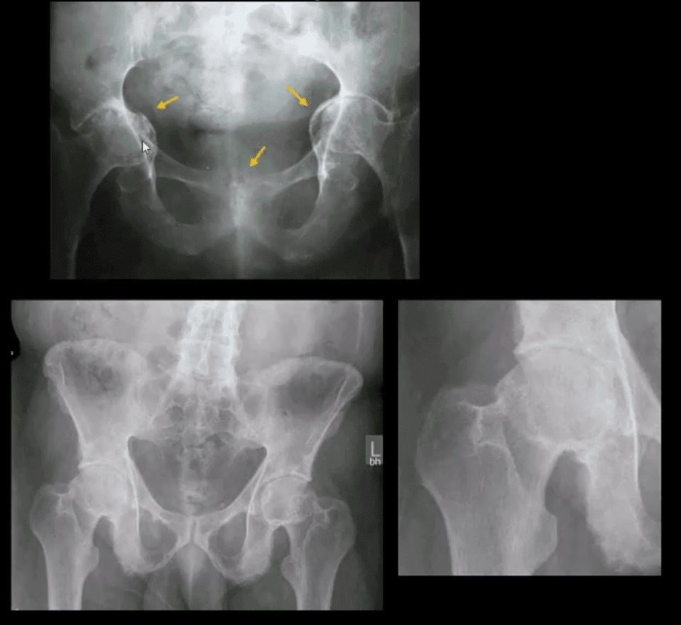 Diagnóstico de artritis de cadera y neoplasias del paso, tx.