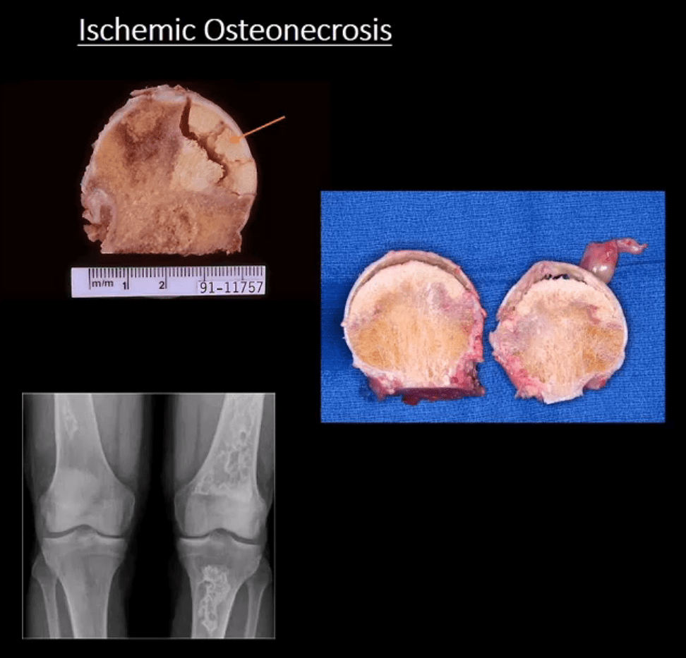 Diagnóstico de artritis de cadera y neoplasias del paso, tx.