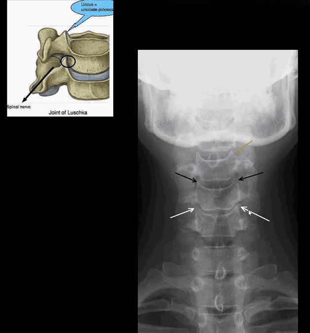 spinal arthritis el paso tx.