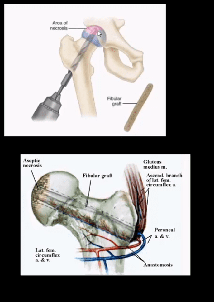 Diagnóstico de artritis de cadera y neoplasias del paso, tx.