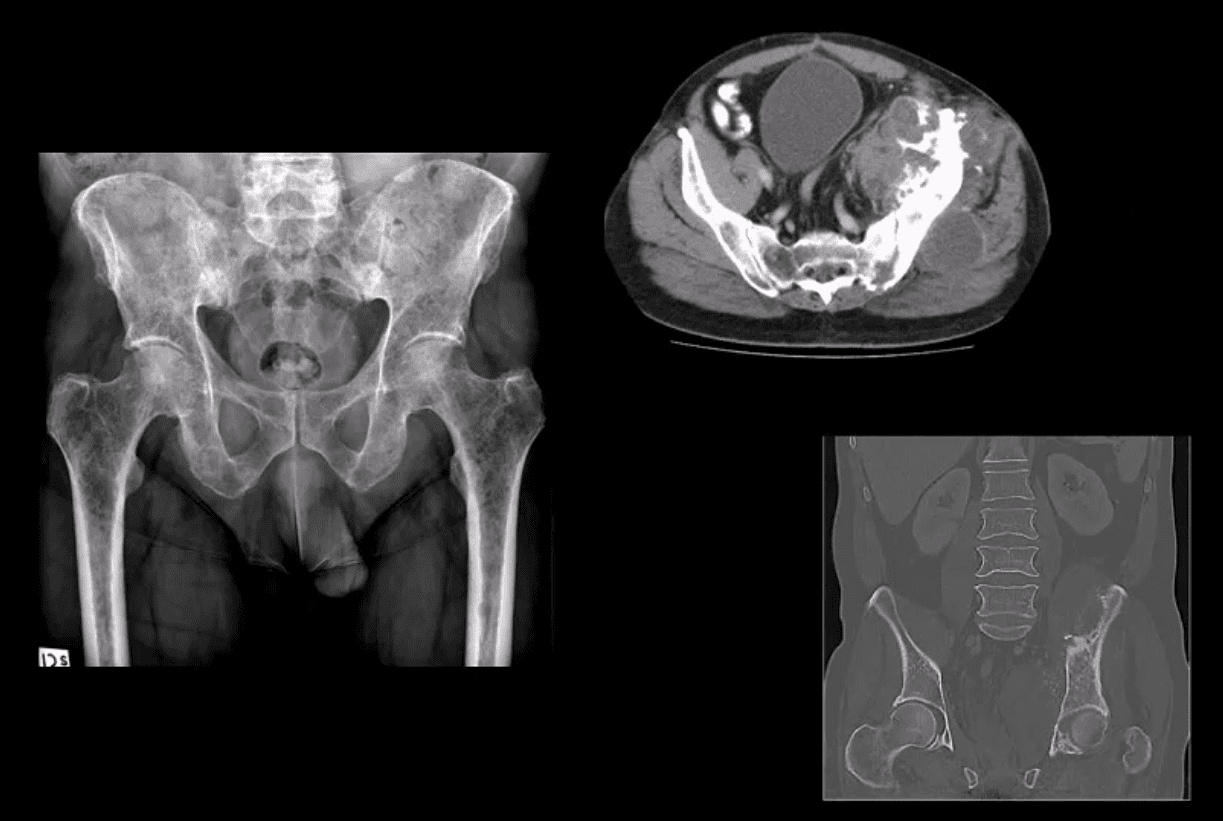 Diagnóstico de artritis de cadera y neoplasias del paso, tx.