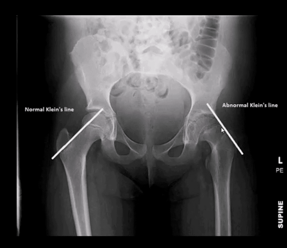 Diagnóstico de artritis de cadera y neoplasias del paso, tx.