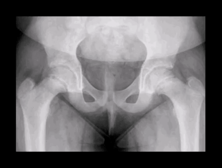 Diagnóstico de artritis de cadera y neoplasias del paso, tx.