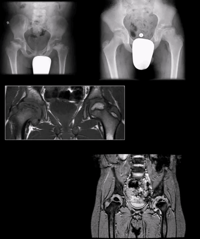 diagnosi artrite e neoplasie dell'anca el paso, tx.