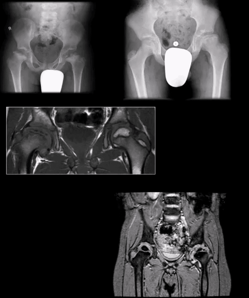 Diagnóstico de artritis de cadera y neoplasias del paso, tx.