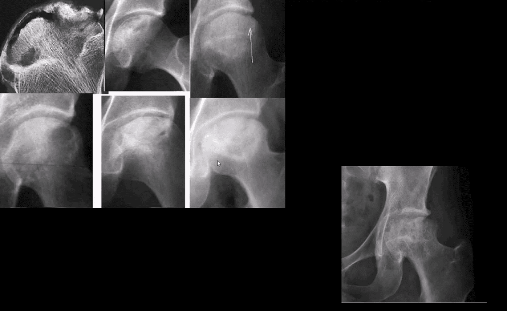 Diagnóstico de artritis de cadera y neoplasias del paso, tx.