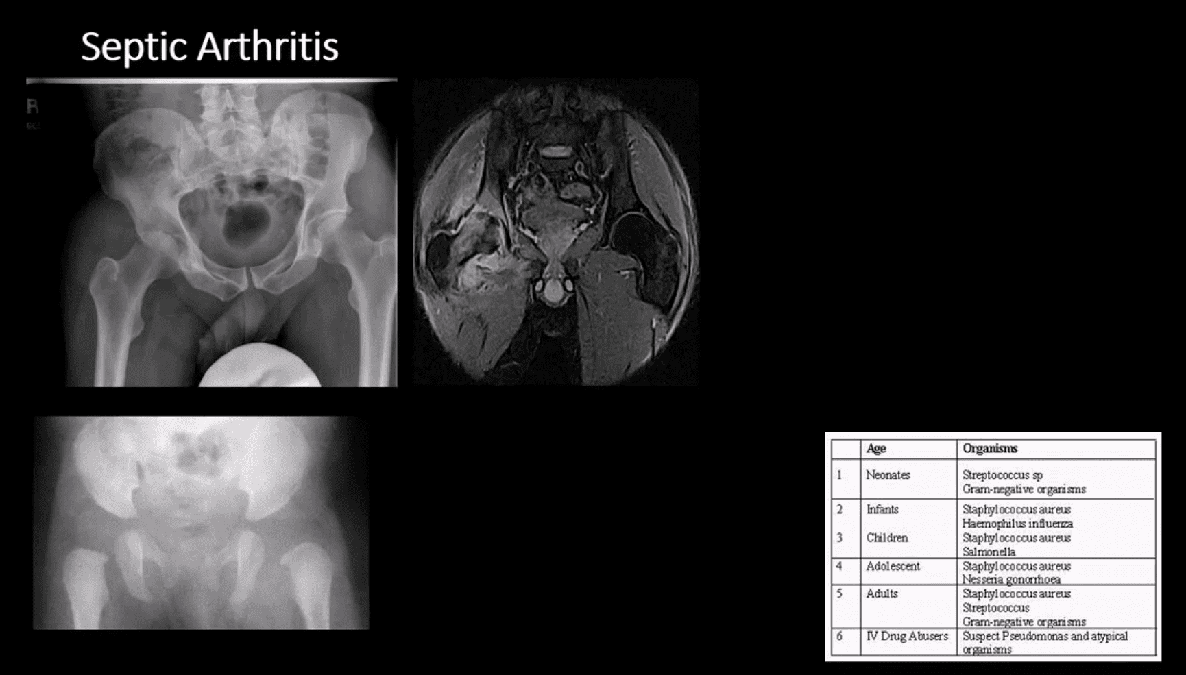 artrite de quadril de diagnóstico e neoplasmas el paso, tx.