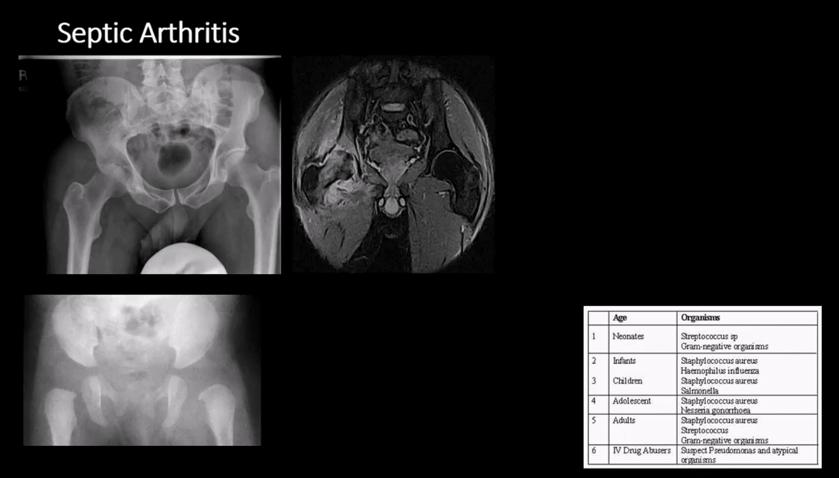 diagnosi artrite e neoplasie dell'anca el paso, tx.