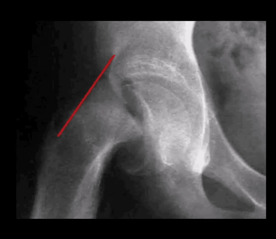 diagnosis hip arthritis and neoplasms el paso, tx.