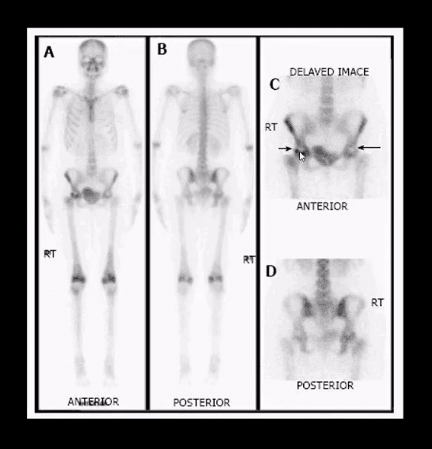 Diagnóstico de artritis de cadera y neoplasias del paso, tx.