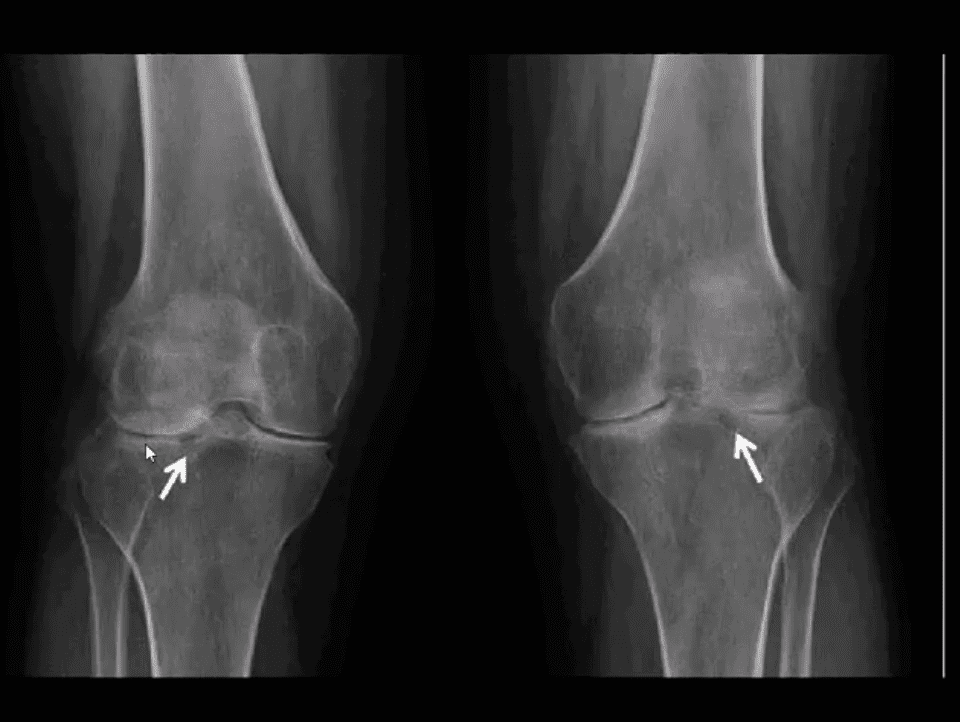 Artritis de rodilla atención quiropráctica el paso tx.