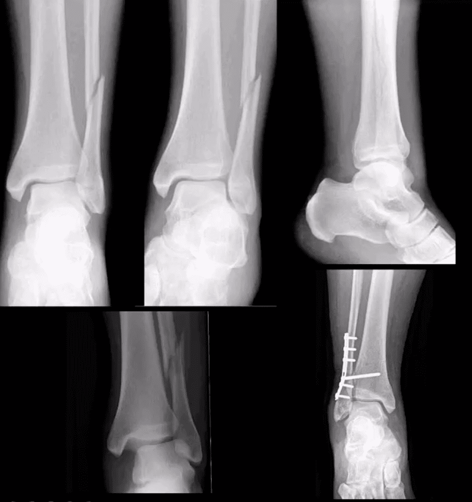 ankle foot arthritis and trauma el paso tx.