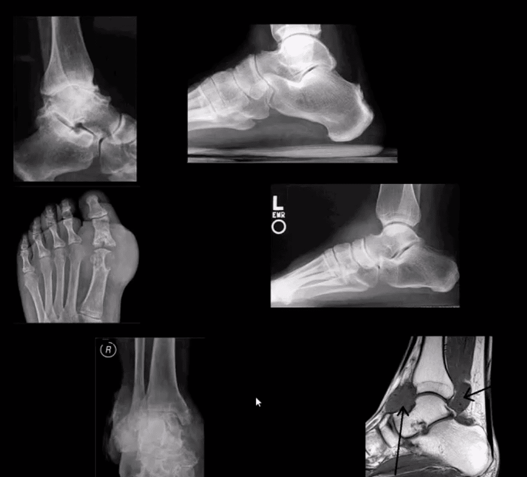 ayak bileği ayağı artrit ve travma el paso tx.