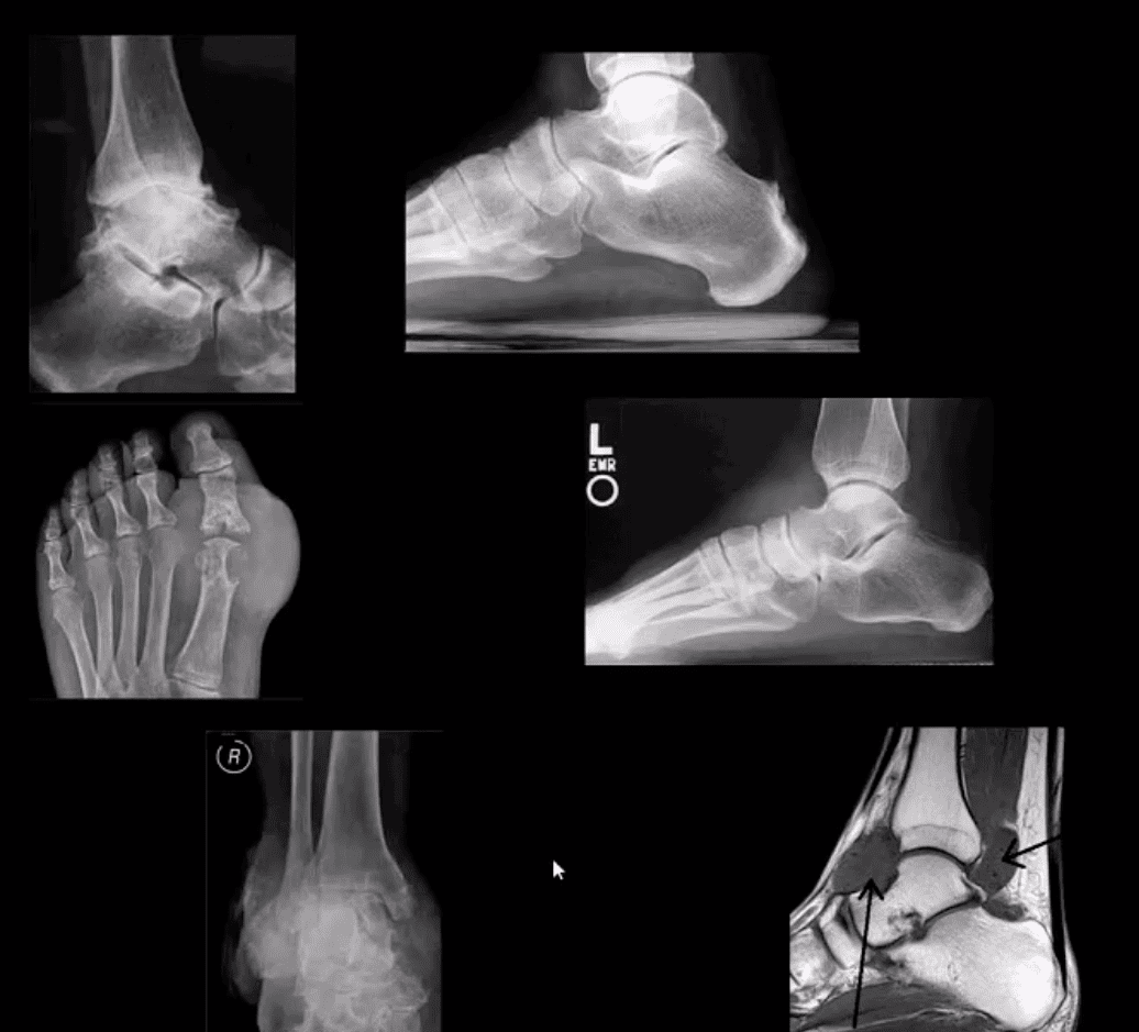 ankle foot arthritis and trauma el paso tx.