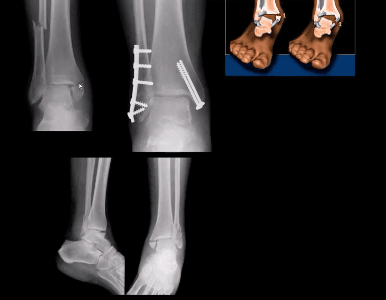 ankle foot arthritis and trauma el paso tx.